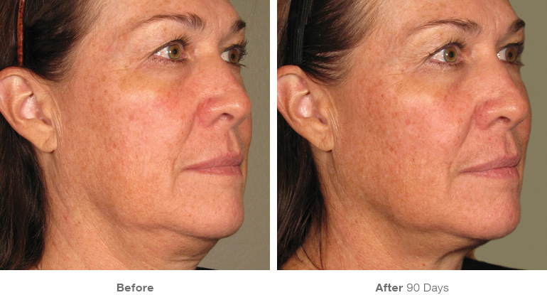 Ultherapy-0058D_0Day-120Day-1TX_BEFOREAFTER_Full
