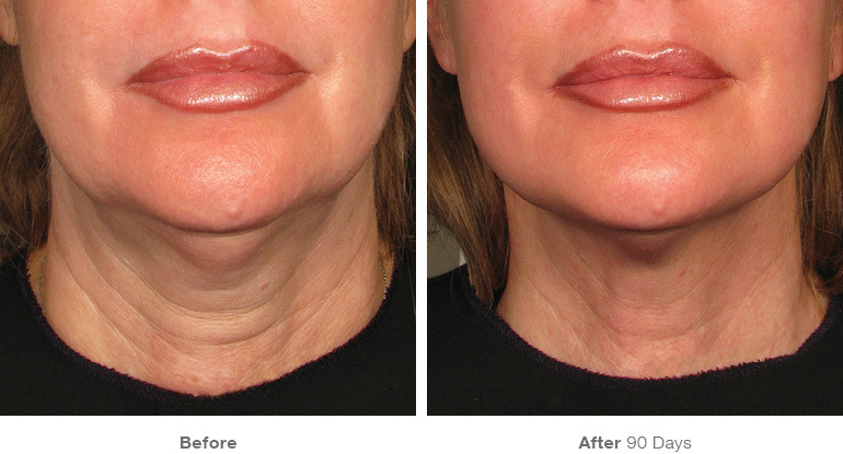 Ultherapy-000P-042Y_0Day-90Day-1TX_BEFOREAFTER_Full
