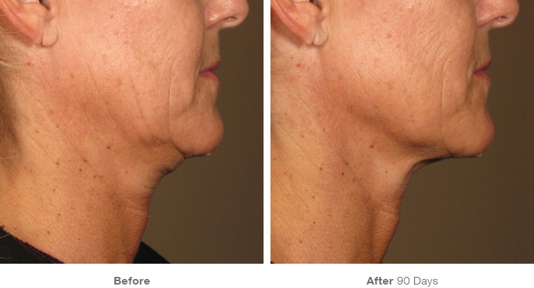 Ultherapy-0058D_0Day-120Day-1TX_BEFOREAFTER_Full