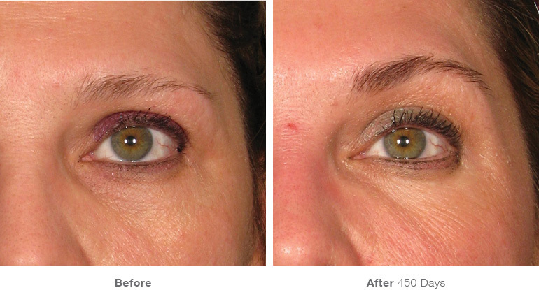 Ultherapy-000P-042Y_0Day-90Day-1TX_BEFOREAFTER_Full